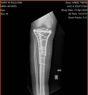 x-ray of my broken tib/fib